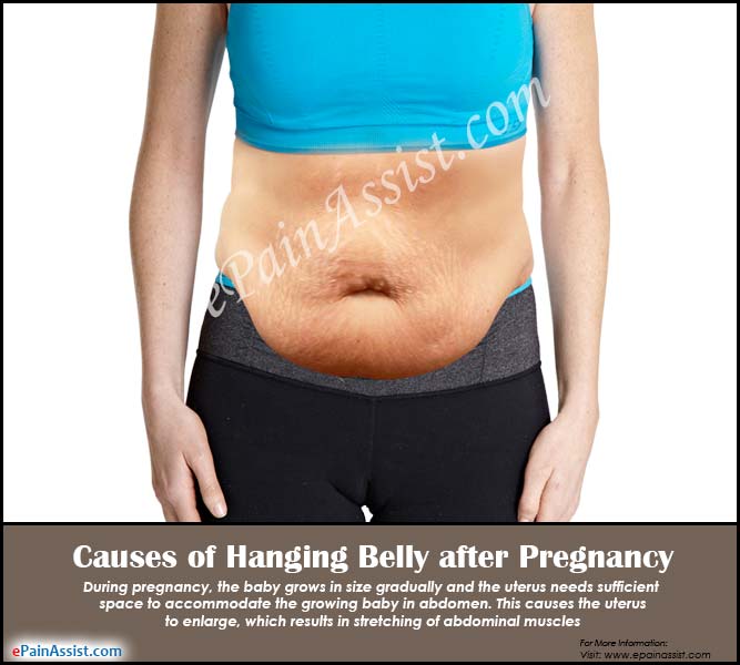 Causes Of Hanging Belly After Pregnancy Ways To Get Rid Of It