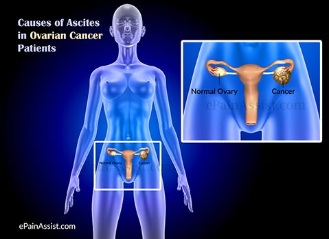 Causes of Ascites in Ovarian Cancer Patients