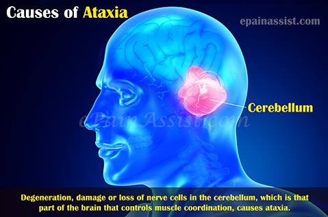 Causes Of Ataxic Gait Or Gait Ataxia