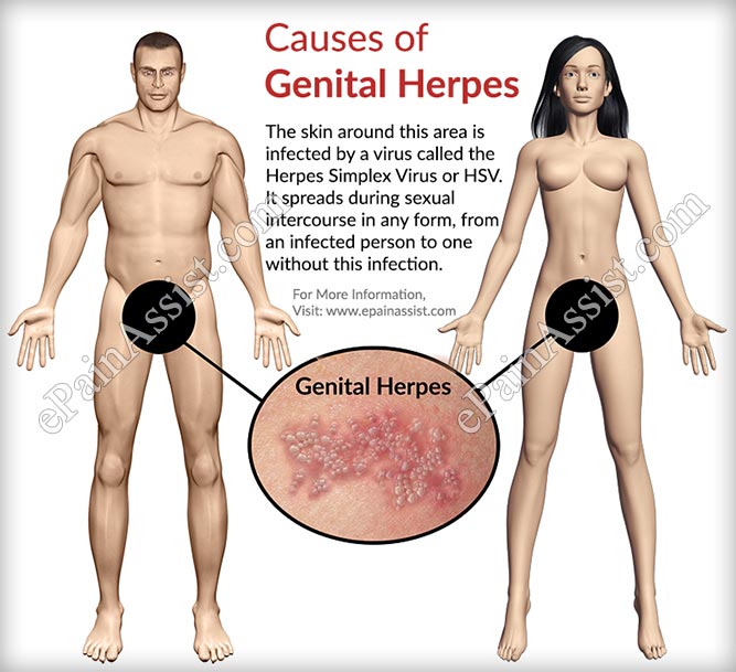 Causes of Genital Herpes