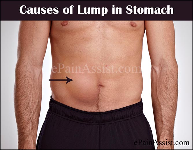 Causes of Lump in Stomach or Abdominal Mass