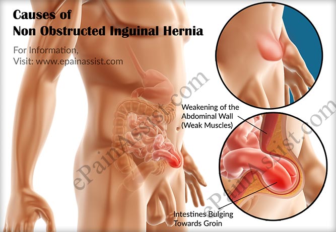 Non Obstructed Inguinal Hernia Causes Signs Symptoms Facts Diagnosis