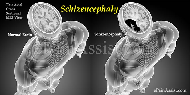 Causes of Schizencephaly