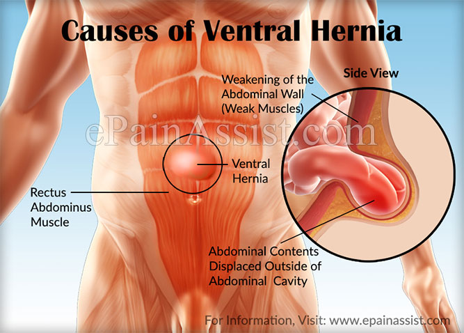 Causes of Ventral Hernia