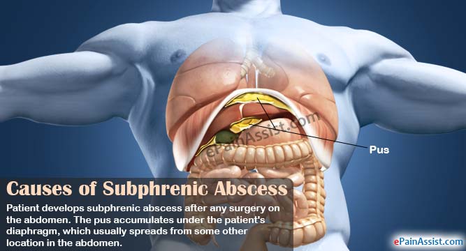 Causes of Subphrenic Abscess Causes of Subphrenic Abscess