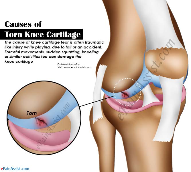 Causes of Torn Knee Cartilage