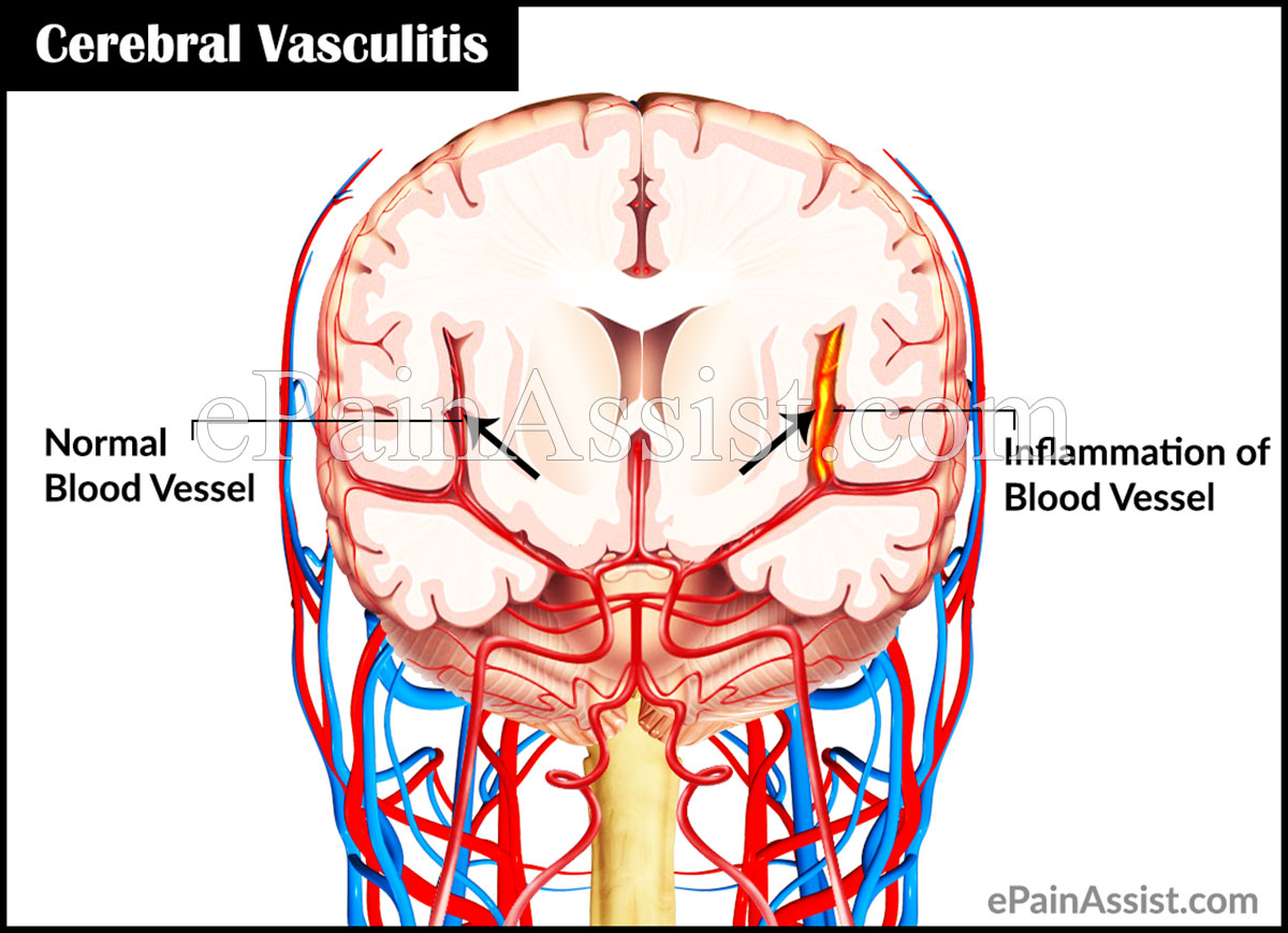 Cerebral Vasculitis