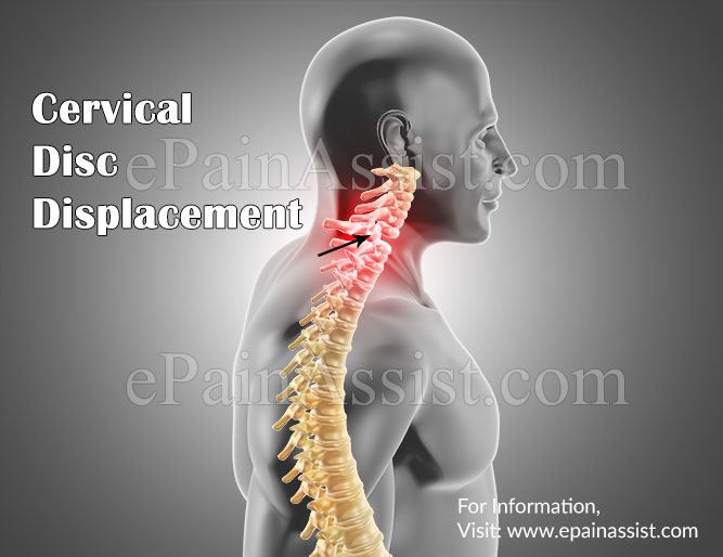 Cervical Disc Displacement