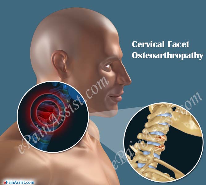 Cervical Facet Osteoarthropathy