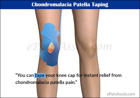 Treatment, Surgery, Recovery of Chondromalacia Patella