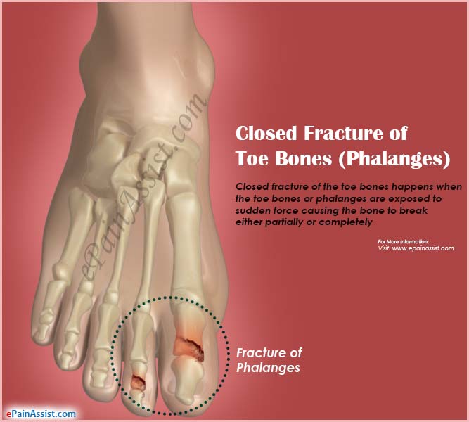 Closed Fracture of Toe Bones (Phalanges) Closed Fracture of Toe Bones (Phalanges)