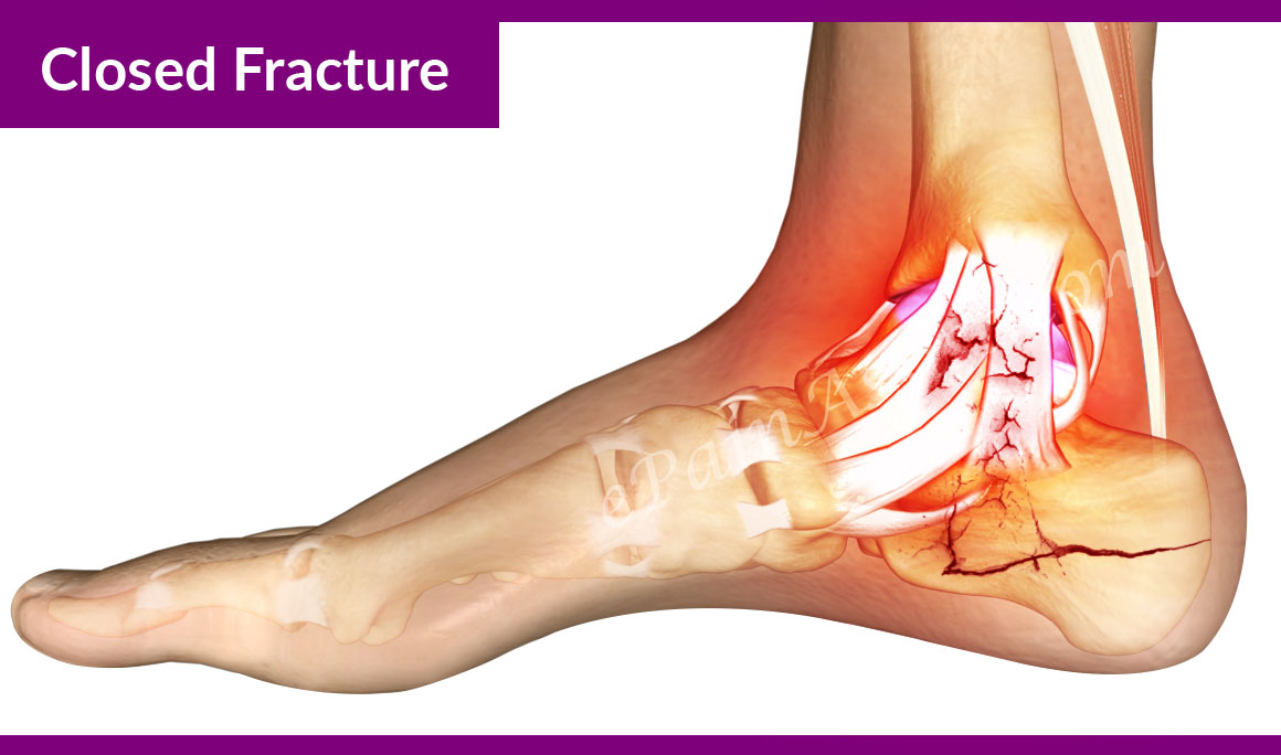 Calcaneus Fracture or Broken HeelTreatmentRecoverySymptomsTypesCauses