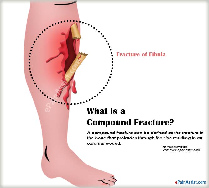 compound fracture