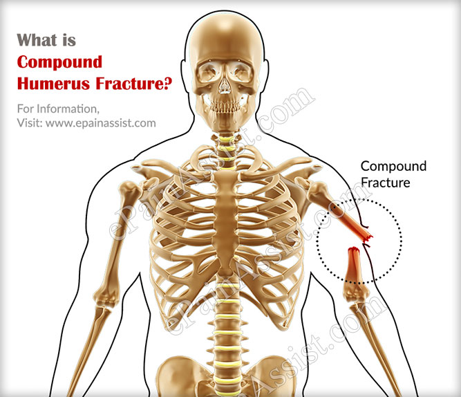 Compound Humerus Fracture