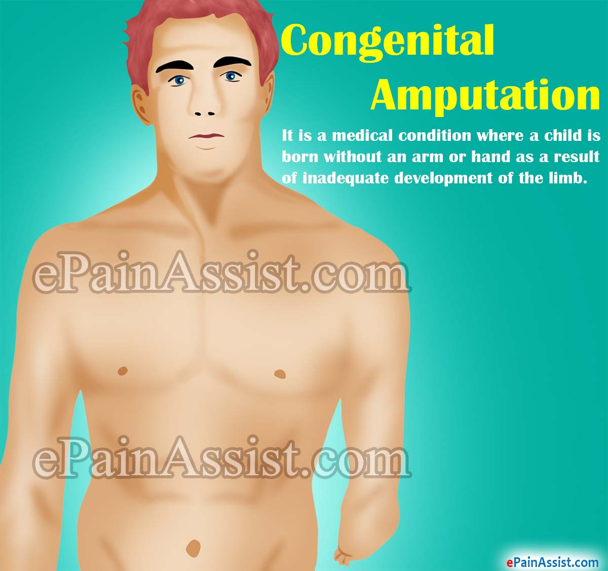 Congenital Amputation Congenital Amputation