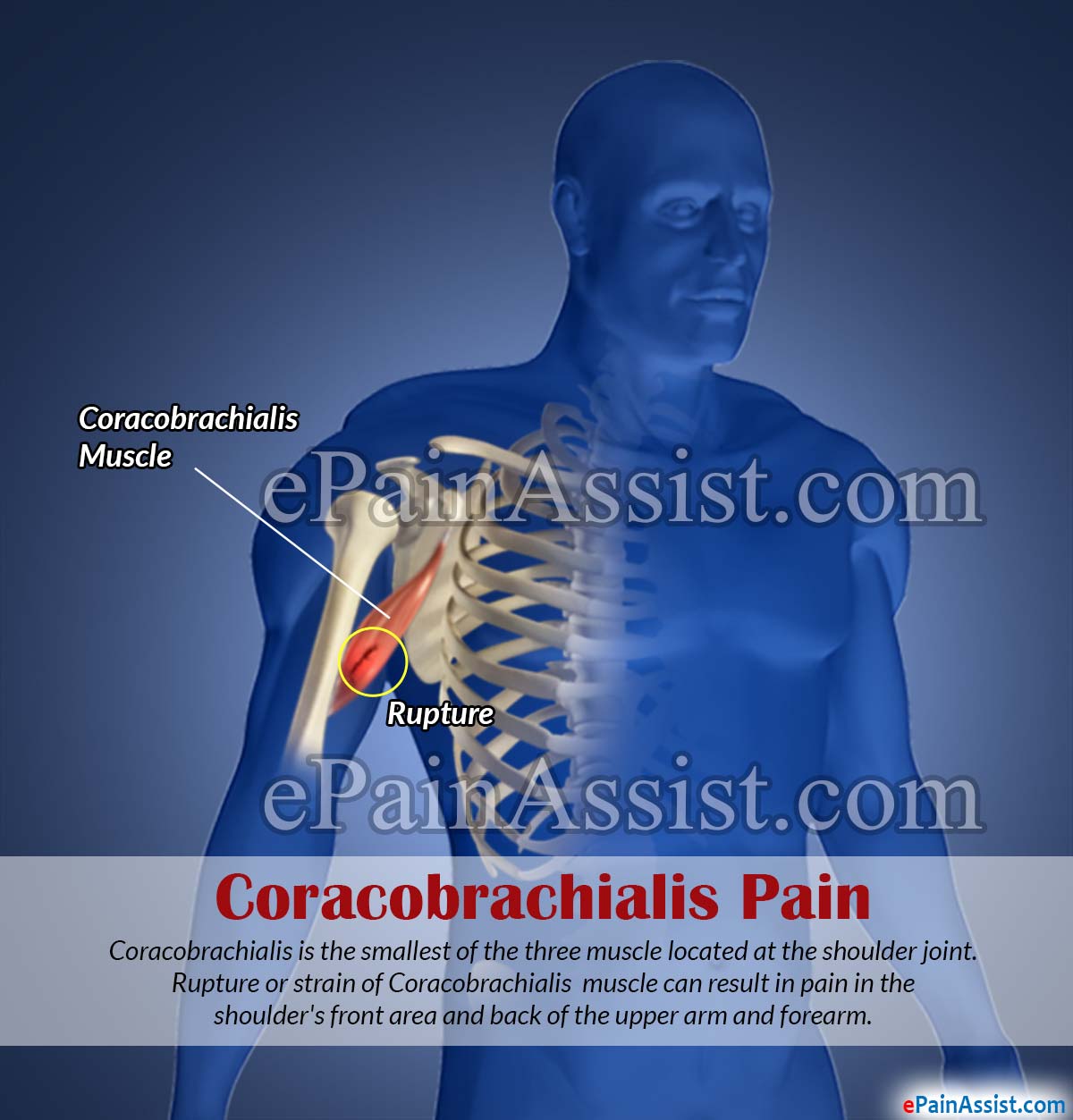 Coracobrachialis Pain or Strain