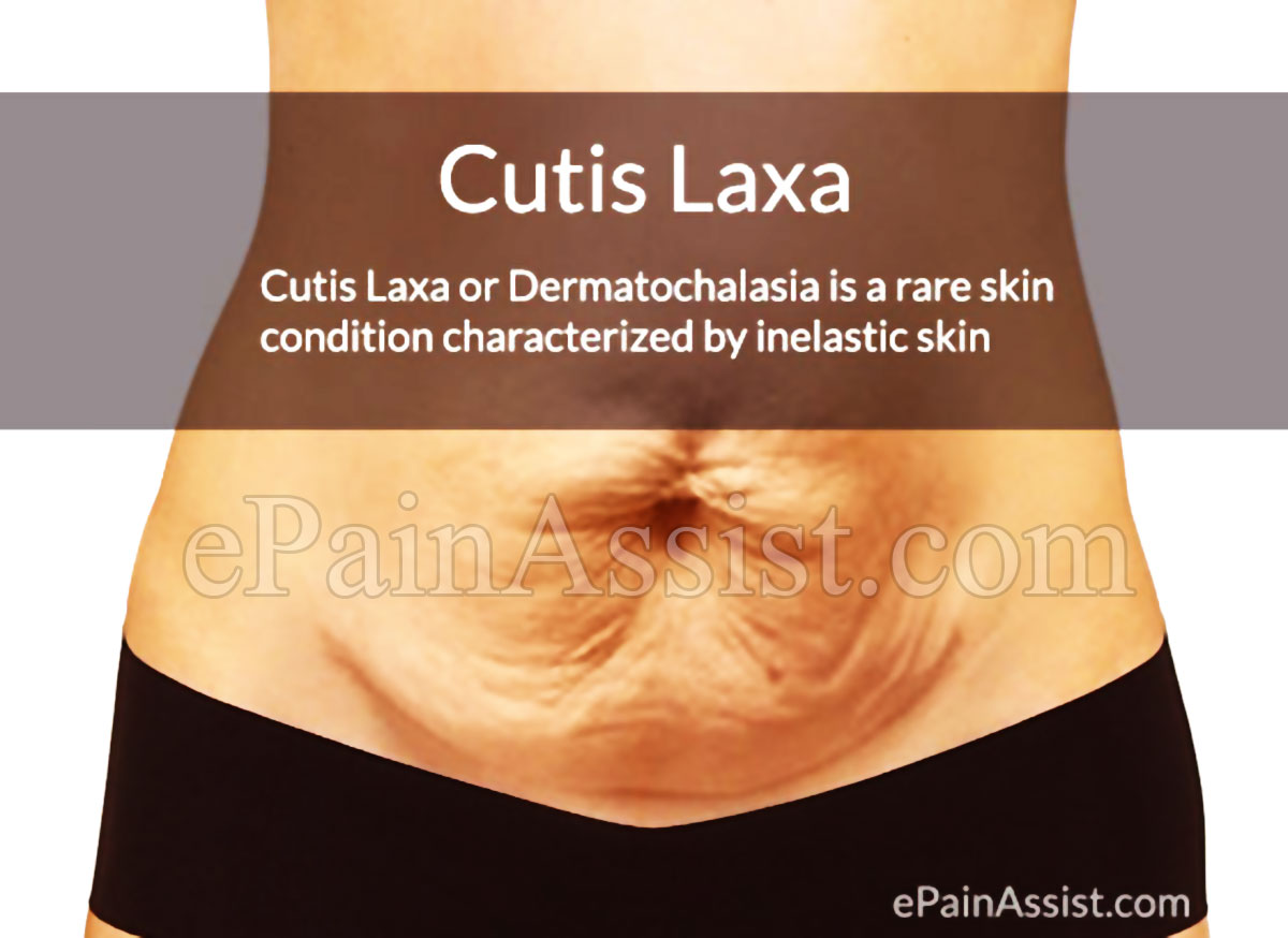 Cutis Laxa or Dermatochalasia Cutis Laxa or Dermatochalasia