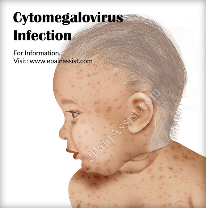 Treatment for CMV Infection or Cytomegalovirus Infection