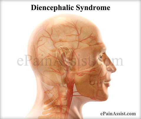 Diencephalic Syndrome Diencephalic Syndrome
