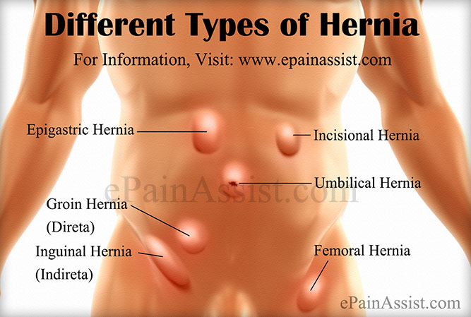 Different Types of Hernia