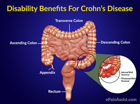 Disability Benefits For Crohn’s Disease