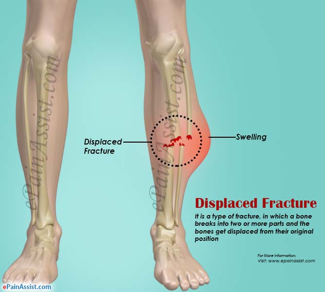 closed displaced fracture