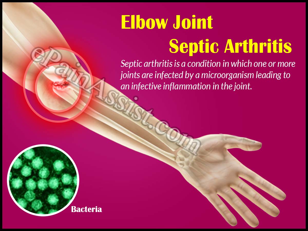 Elbow Joint Septic Arthritis Elbow Joint Septic Arthritis
