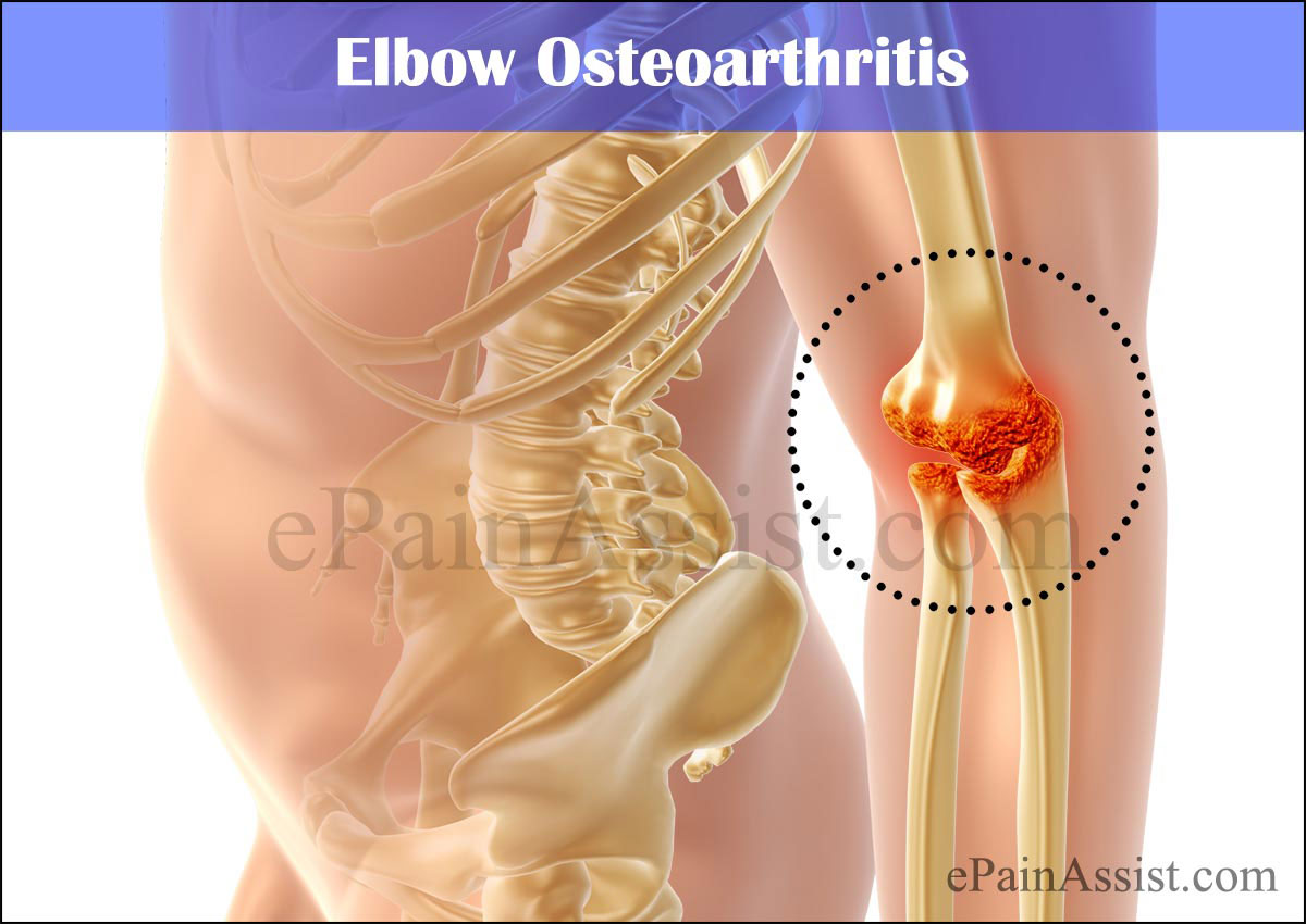 Elbow Osteoarthritis Elbow Osteoarthritis