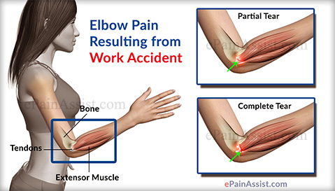 Elbow Pain Resulting from Work Accident