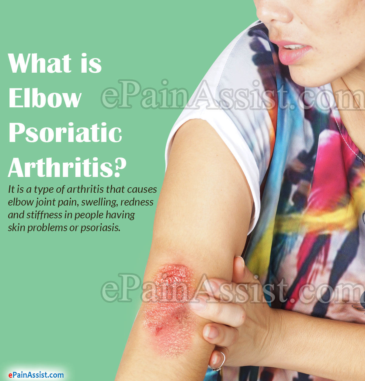 Elbow Psoriatic Arthritis Elbow Psoriatic Arthritis