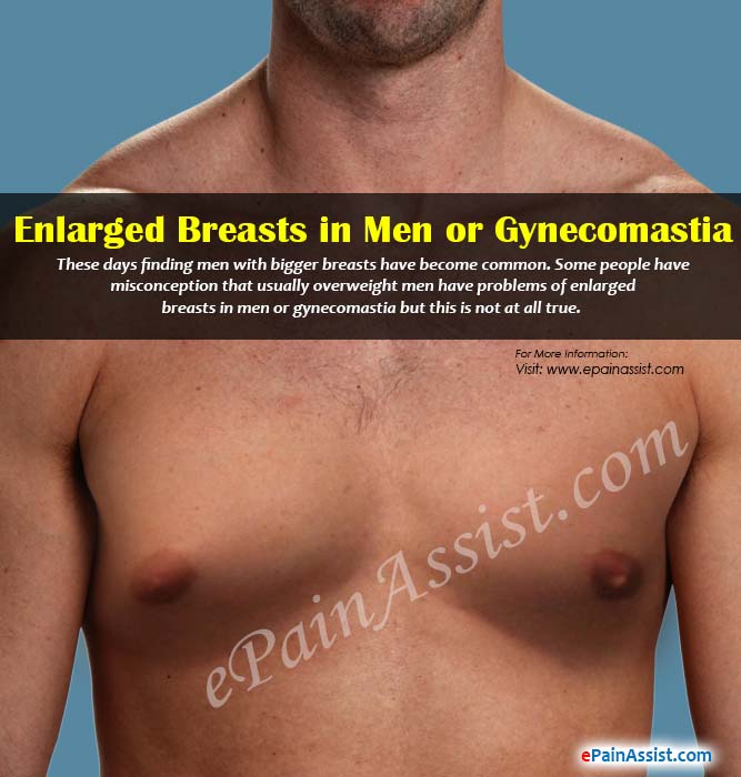 Enlarged Breasts in Men or Gynecomastia Enlarged Breasts in Men or Gynecomastia