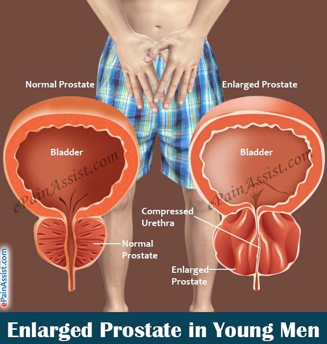 how to reduce prostate enlargement naturally