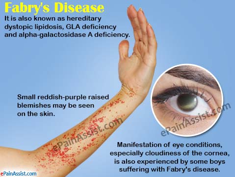 Fabry's Disease or Hereditary Dystopic Lipidosis