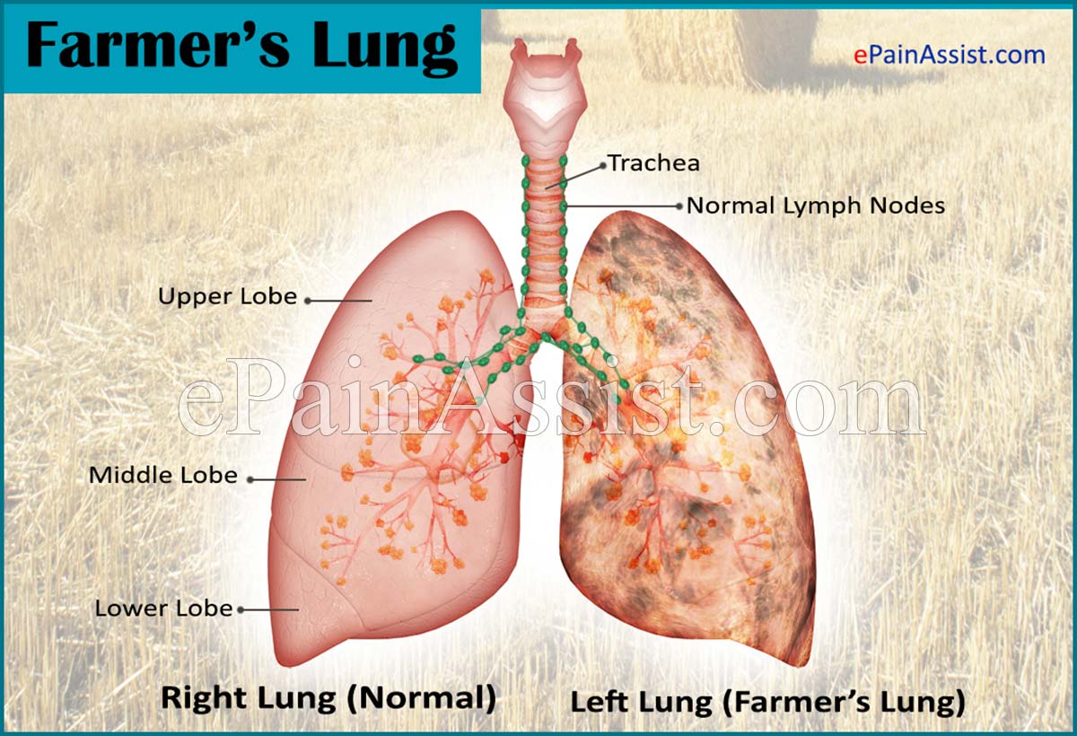 Farmer’s Lung- Causes, Symptoms, Diagnosis, Treatment