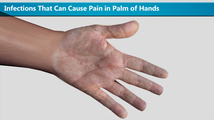 infections-that-can-cause-pain-in-palm-of-hands