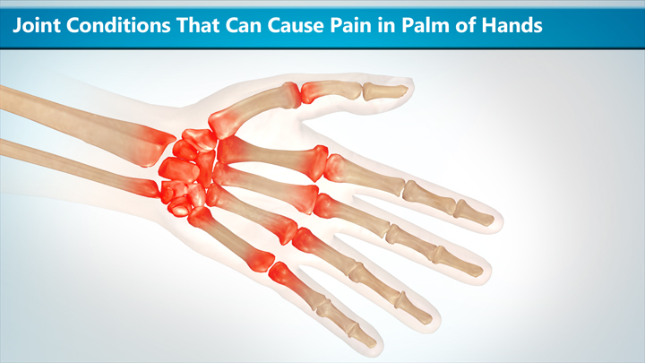 joint-conditions -that-can-cause-pain-in-palm-of-hands