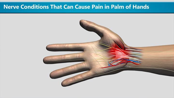 nerve-conditions-that-can-cause-pain-in-palm-of-hands