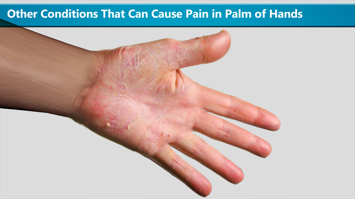 other-conditions-that-can-cause-pain-in-palm-of-hands