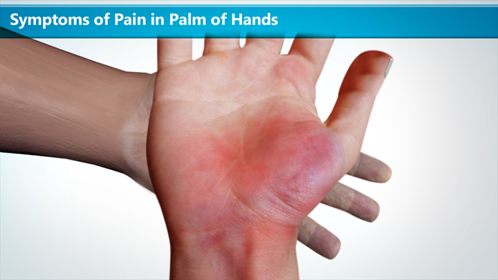 symptoms-of-pain-in-palm-of-hands