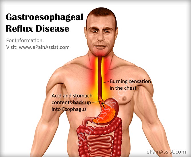 GERD may cause your throat to feel tight after eating