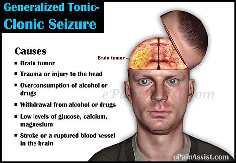 Generalized Tonic-Clonic Seizure or Grand Mal Seizure Generalized Tonic-Clonic Seizure or Grand Mal Seizure