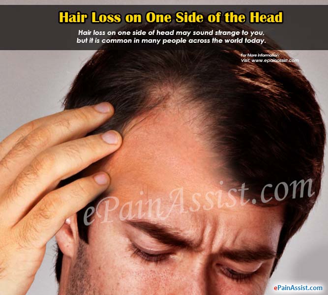 Hair Loss on One Side of the Head