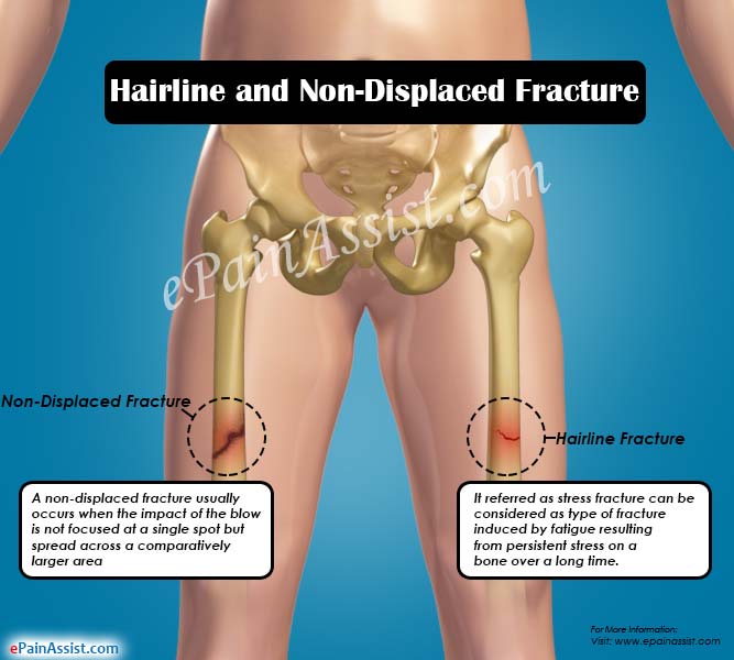 What is a nondisplaced fracture?