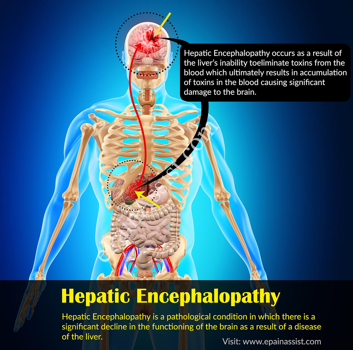 Hepatic Encephalopathy