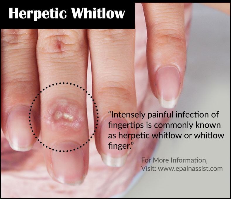 Pediatric Herpes Simplex Virus Infection Clinical ...