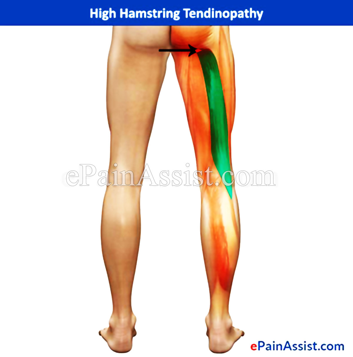High Hamstring Tendinopathy