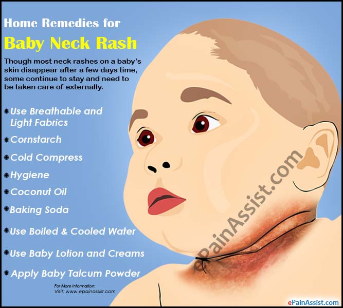 Home Remedies for Baby Neck Rash