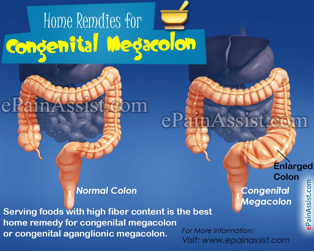 Home Remedies for Congenital Megacolon or Congenital Aganglionic Megacolon Home Remedies for Congenital Megacolon or Congenital Aganglionic Megacolon