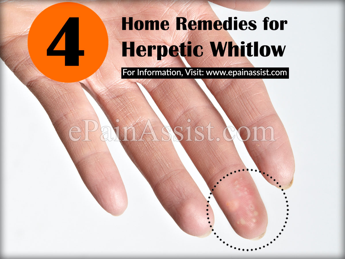 Home Remedies for Herpetic Whitlow or Whitlow Finger