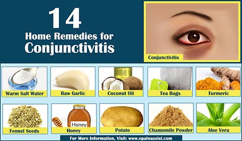 Home Remedies for Pink Eye or Conjunctivitis Home Remedies for Pink Eye or Conjunctivitis